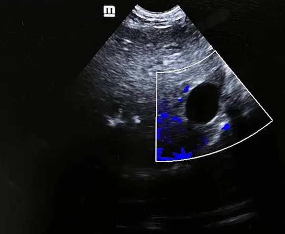 Ultrasound and echocardiography